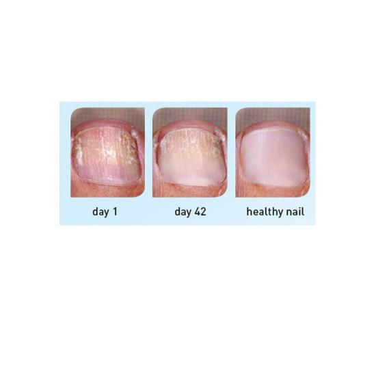 Excilor Pen - Nail Fungal Infection Treatment Excilor Pen - Nail Fungal Infection Treatment